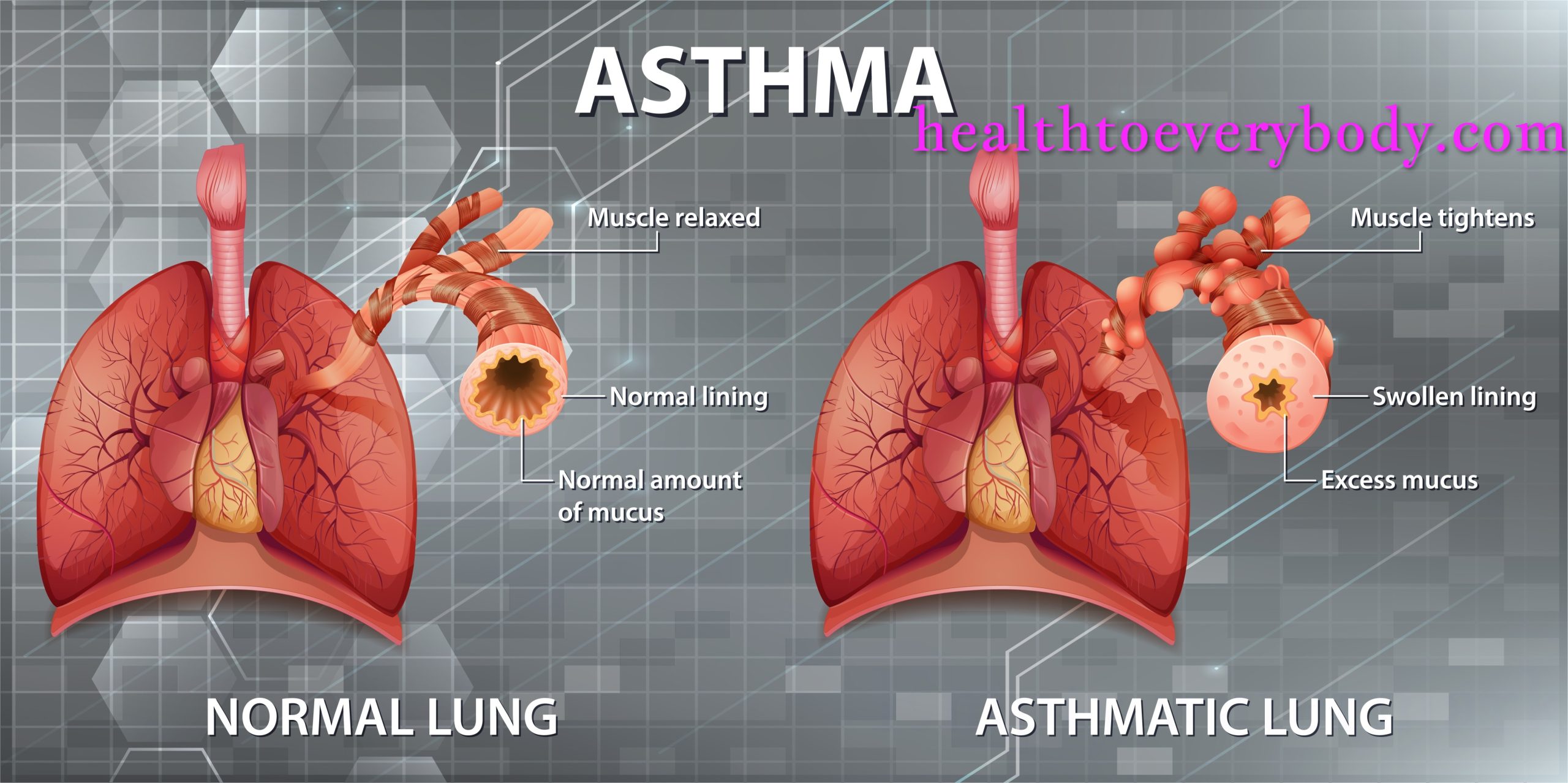 Bronchial Asthma 